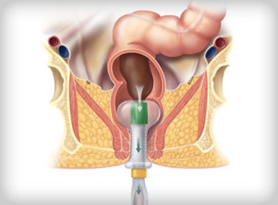 An anatomical illustration of the hygh-tec fecal management system inside an anus