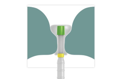 A cartoon illustration of the fecal management system