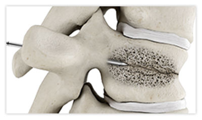 Step 1: Guide needle into fractured vertebra using fluoroscopy