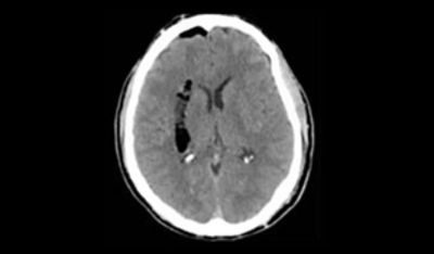 ich-evacuation-clinical-impact_post-op