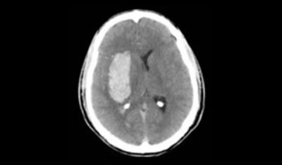 ich-evacuation-clinical-impact_pre-op