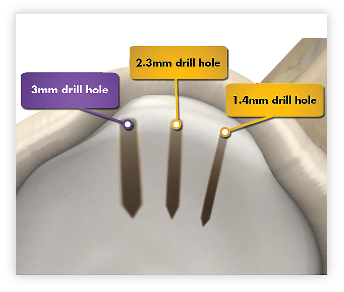 iconix minimal bone removal 3mm drill hole comparison to iconix 2.3mm and 1.4mm drill holes