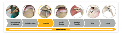 Chart showing the range of treatments from least to most invasive in the shoulder continuum of care