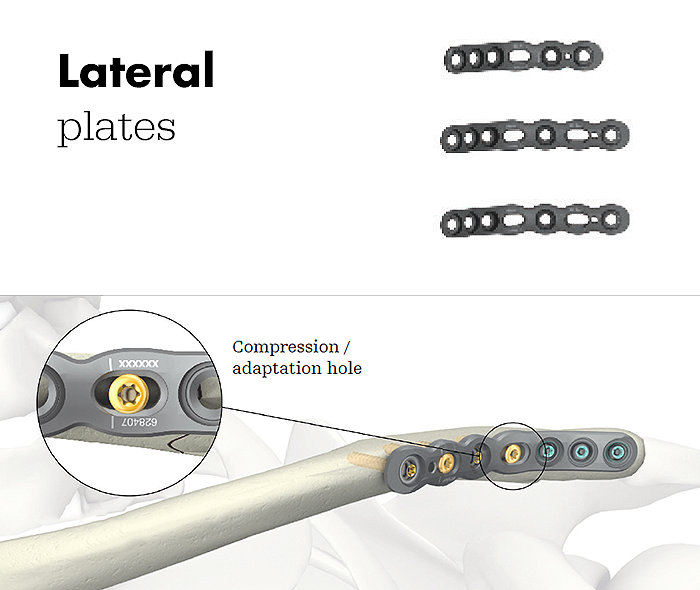Lateral Plates