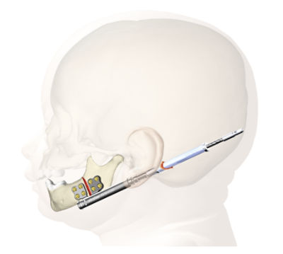 Uma visão do interior de uma placa de reconstrução mandibular