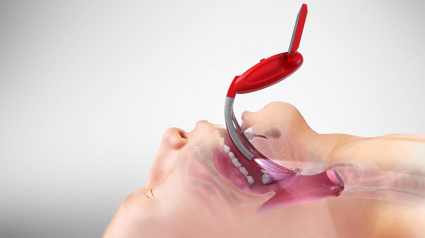 Vue latérale du vidéo-laryngoscope McGRATH MAC EMS inséré dans la bouche d'un patient