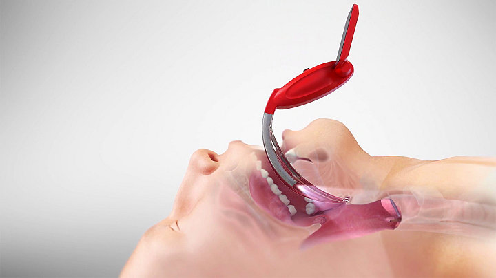 Illustration d'un vidéo-laryngoscope McGRATH MAC EMS inséré dans la bouche d'un patient