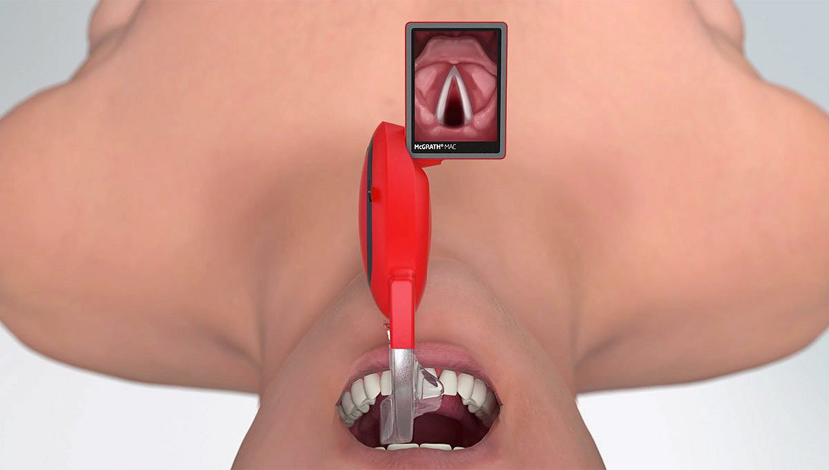 Vue d'ensemble du vidéo-laryngoscope McGRATH MAC EMS inséré dans la bouche d'un patient