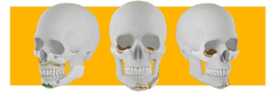 medpor-implant-group-image