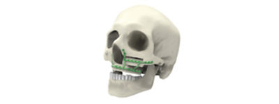 midface-reconstruction