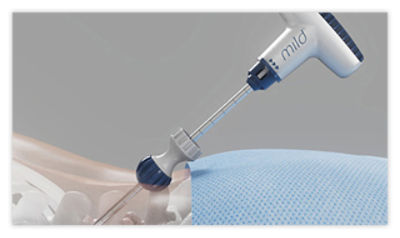 Step 1: Make incision (5.1mm) and insert portal, trocar, portal stabilizer and depth guide to access treatment area