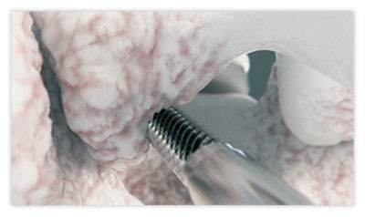 Step 2: If needed, use access auger to help facilitate access