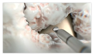 Step 3: Remove bone to achieve access