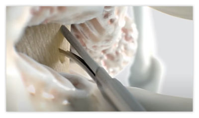 Step 4: Debulk hypertrophic ligament