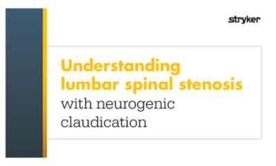 This blog offers practical guidance to understanding lumbar spinal stenosis with neurogenic claudication