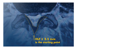 Excess hypertrophic ligamentum flavum, a possible symptom seen in typical mild® patients