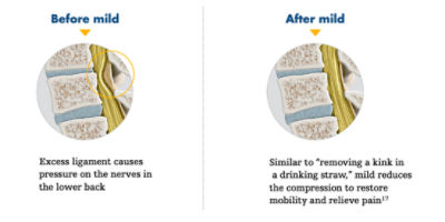 mild® addresses this major root cause of LSS, by removing excess ligament tissue using specialized tools and imaging