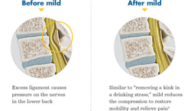 mild_before-and-after