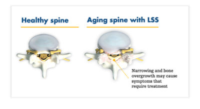 Lumbar spinal stenosis is often caused by an enlarged ligament in the back, which compresses the space around the spinal canal and puts pressure on the nerves in the lower back
