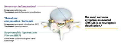 Lumbar spinal stenosis, (LSS) is a common condition in which the lower spinal canal narrows and compresses the nerves in the lower back