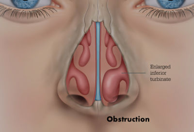 turbinates