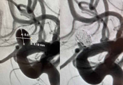 Target Tetra Case Spotlight: ICA (ophthalmic segment) aneurysm 