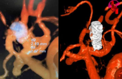 Target Tetra Case Spotlight: Residual ACOM aneurysm 