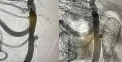Target Tetra Case spotlight: Ruptured basilar fenestration aneurysm