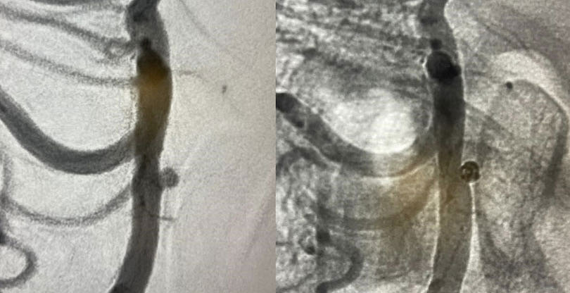 Target Tetra Case spotlight: Ruptured basilar fenestration aneurysm