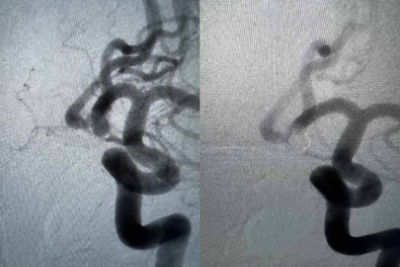 Target Tetra Case Spotlight: Unruptured ACOM aneurysm