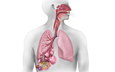 Medical illustration of pneumonia in the lungs