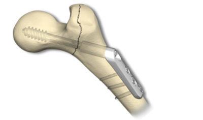 Omega 3 Hip Screw