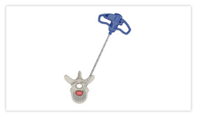 Step 1: insert access cannula and advance to the posterior 1/3 of the vertebral body