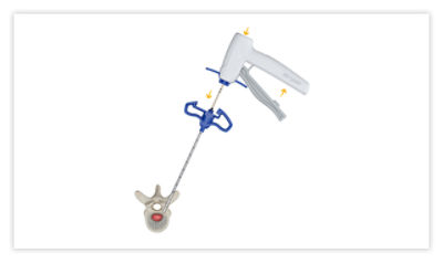 Step 2: Insert introducer with sheath, then squeeze the gray introducer lever. Advance introducer using a mallet