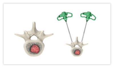 Step 1: Insert access cannulas and advance to the posterior 1/3 of the vertebral body