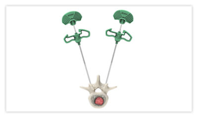 Step 2: Insert hand drill into the anterior third of the vertebral body to create a pathway