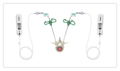 Step 3: Insert OptaBlate probes and connect microinfuser to begin the flow of sterile saline to the lesion site