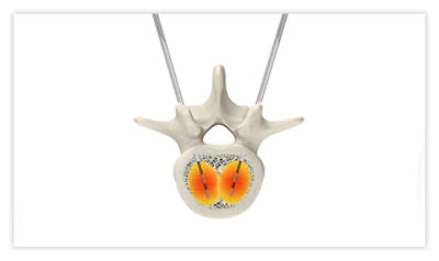Step 4: Ablate surrounding tissue using radiofrequency energy