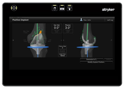 Navigation image of the femoral component planning. The size of the