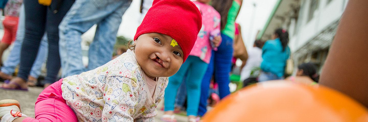 Child with cleft lip