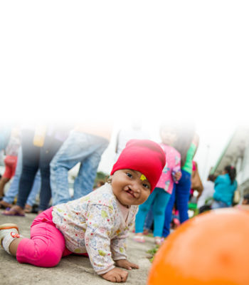 Child with cleft lip