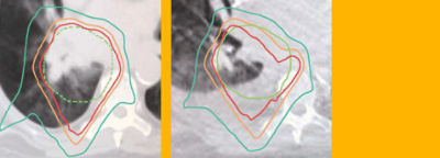 Left: Image of fluid accumulation in lungs (original)  Right: Image of fluid accumulation in lungs (3 weeks later) 