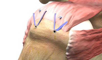 rcr-CTA-thumb