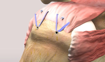 Click here to learn more about our full rotator cuff repair portfolio