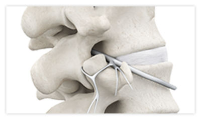 A spine following the completion of the radiofrequency ablation procedure and relief of nerve pain