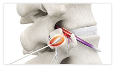 Step 3: Use radiofrequency current to heat surrounding nerve(s) tissue to create lesions.