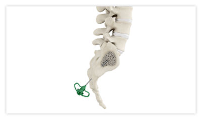 A spine showing needles being inserted through a small incision in preparation for sacroplasty treatment