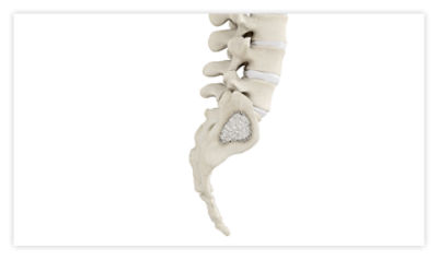 A spine after the sacrum is filled with bone cement following the sacroplasty procedure