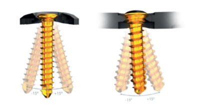 VariAx 2 Compression Plating System