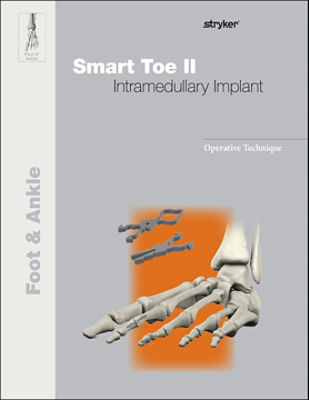 Smart Toe II operative technique
